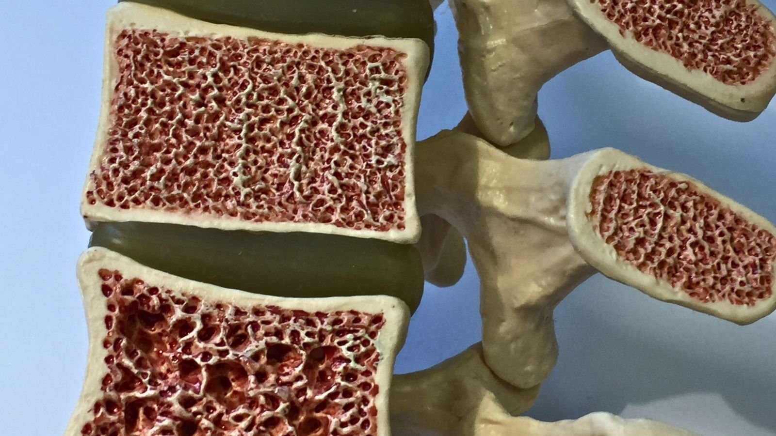 Osteoporosis and the Price of Comfort in Modern Life